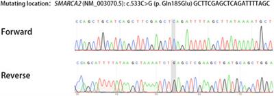 Living birth following preimplantation genetic testing for monogenic disorders to prevent low-level germline mosaicism related Nicolaides–Baraitser syndrome